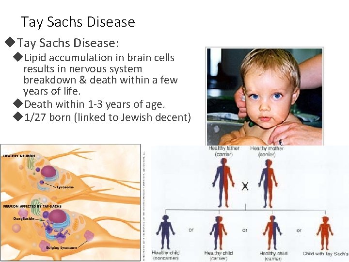 Tay Sachs Disease: Lipid accumulation in brain cells results in nervous system breakdown &