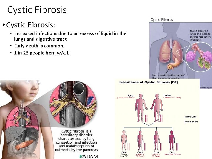 Cystic Fibrosis • Cystic Fibrosis: • Increased infections due to an excess of liquid