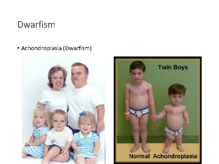 Dwarfism • Achondroplasia (Dwarfism) 