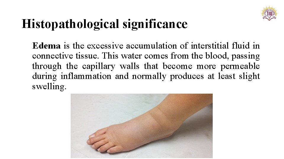 Histopathological significance Edema is the excessive accumulation of interstitial fluid in connective tissue. This