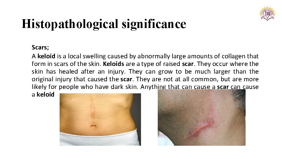Histopathological significance Scars; A keloid is a local swelling caused by abnormally large amounts
