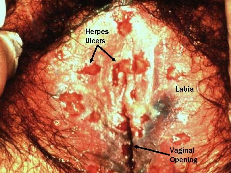 Herpes Ulcers Labia Vaginal Opening 