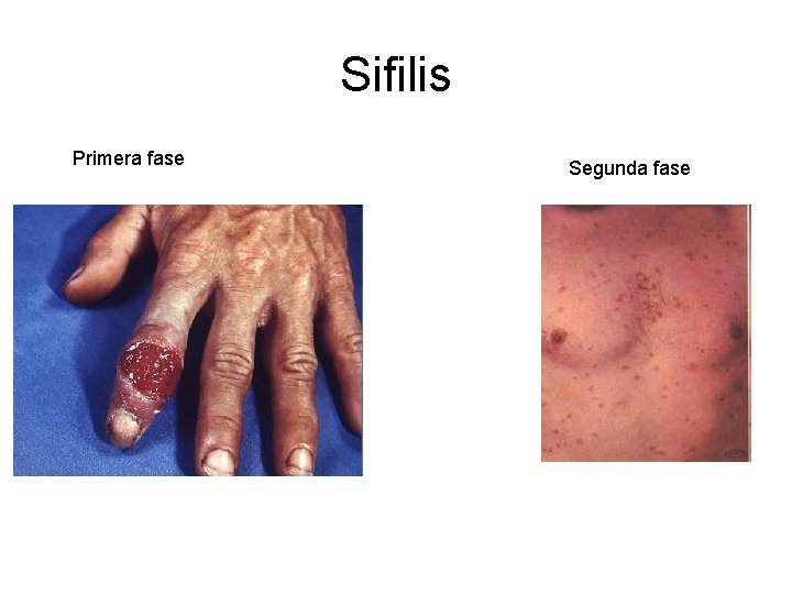 Sifilis Primera fase Segunda fase 