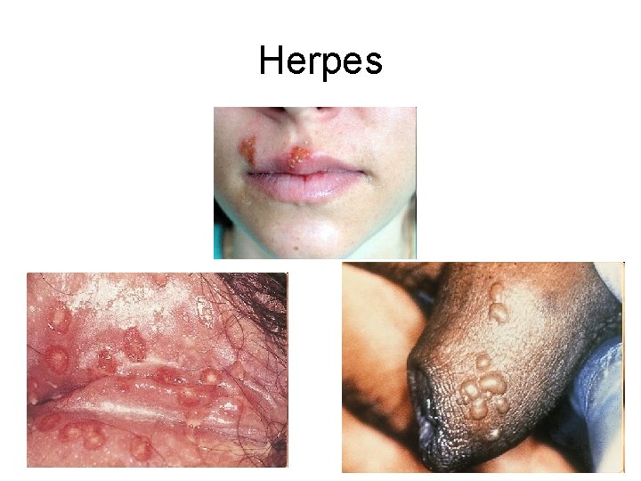 Herpes 