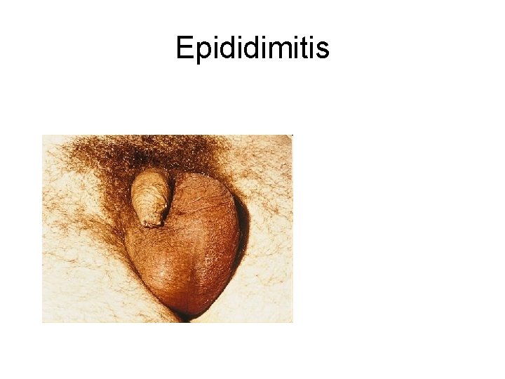 Epididimitis 