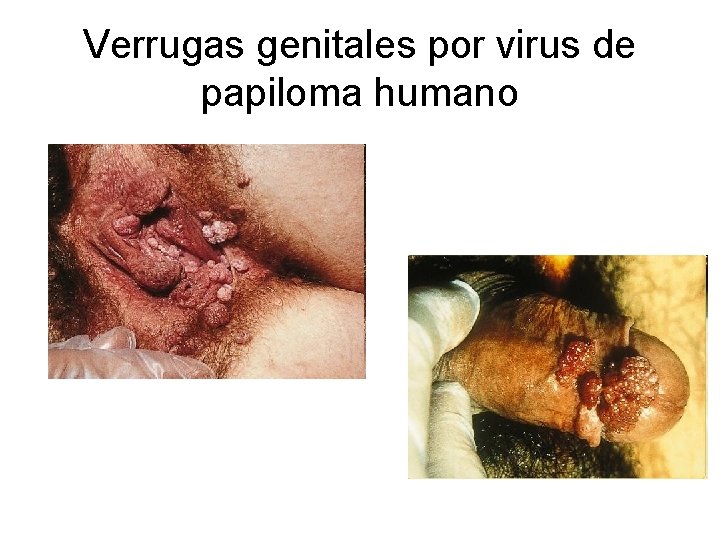 Verrugas genitales por virus de papiloma humano 