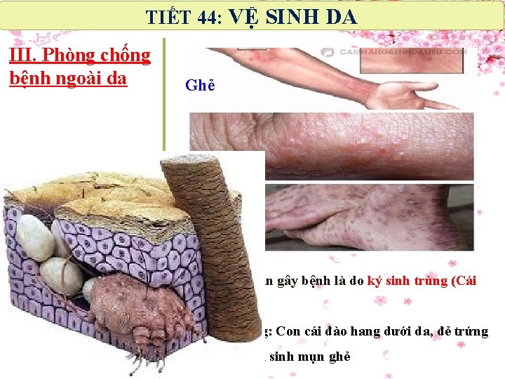 TIẾT 44: VỆ SINH DA III. Phòng chống bệnh ngoài da Ghẻ § Nguyên