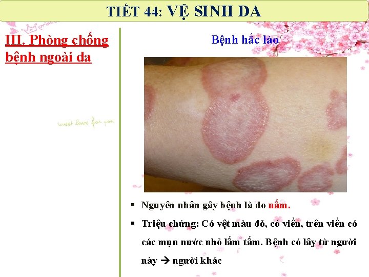 TIẾT 44: VỆ SINH DA III. Phòng chống bệnh ngoài da Bệnh hắc lào