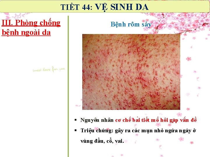 TIẾT 44: VỆ SINH DA III. Phòng chống bệnh ngoài da Bệnh rôm sảy TIẾT 44: VỆ SINH DA III. Phòng chống bệnh ngoài da Bệnh rôm sảy