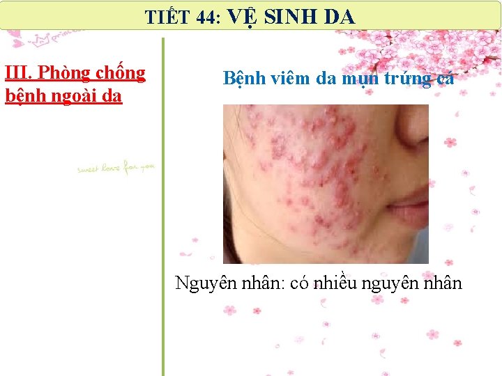 TIẾT 44: VỆ SINH DA III. Phòng chống bệnh ngoài da Bệnh viêm da TIẾT 44: VỆ SINH DA III. Phòng chống bệnh ngoài da Bệnh viêm da