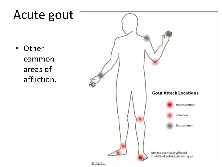 Acute gout • Other common areas of affliction. 