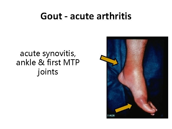 Gout - acute arthritis acute synovitis, ankle & first MTP joints 