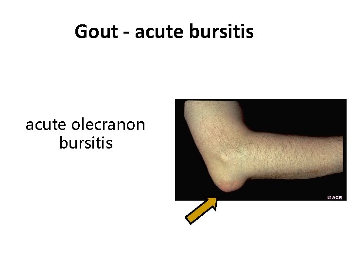 Gout - acute bursitis acute olecranon bursitis 