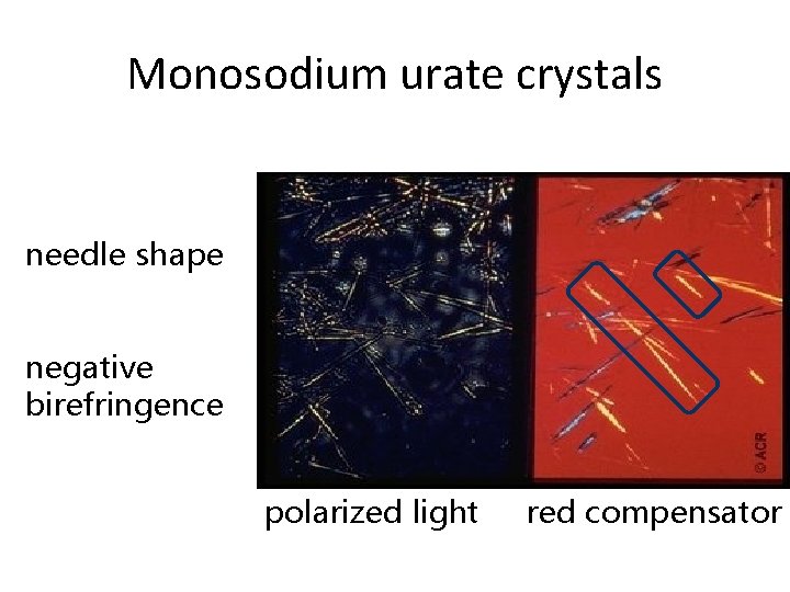 Monosodium urate crystals needle shape negative birefringence polarized light red compensator 