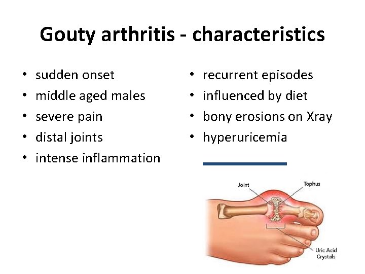 Gouty arthritis - characteristics • • • sudden onset middle aged males severe pain