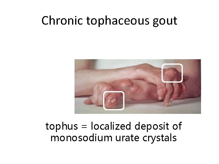Chronic tophaceous gout tophus = localized deposit of monosodium urate crystals 