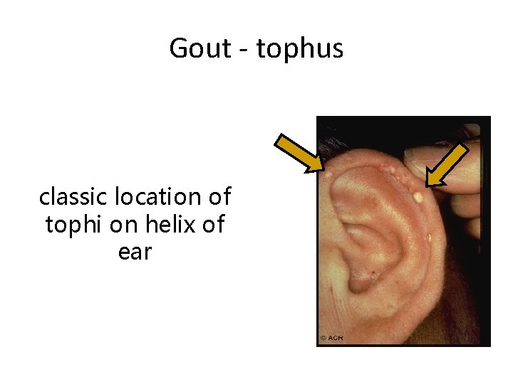 Gout - tophus classic location of tophi on helix of ear 