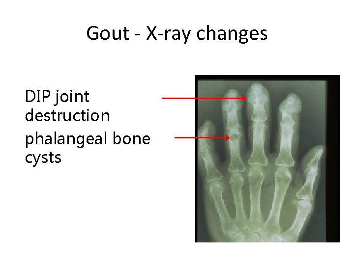 Gout - X-ray changes DIP joint destruction phalangeal bone cysts 