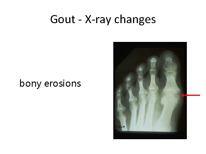 Gout - X-ray changes bony erosions 