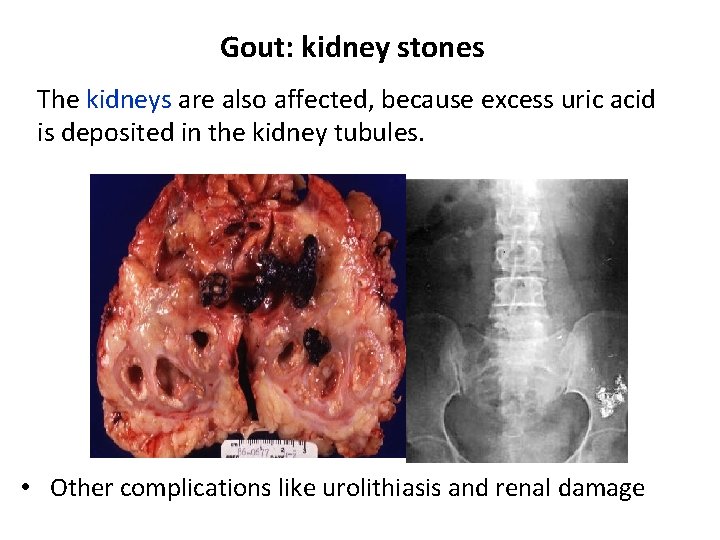 Gout: kidney stones The kidneys are also affected, because excess uric acid is deposited