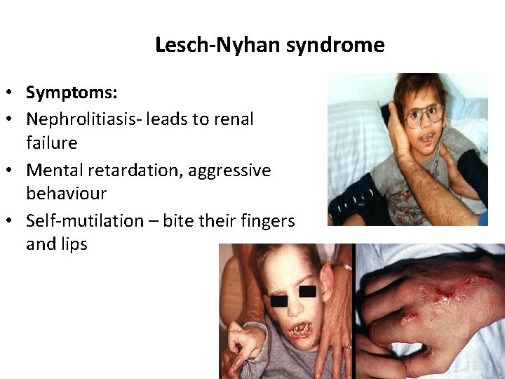 Lesch-Nyhan syndrome • Symptoms: • Nephrolitiasis- leads to renal failure • Mental retardation, aggressive