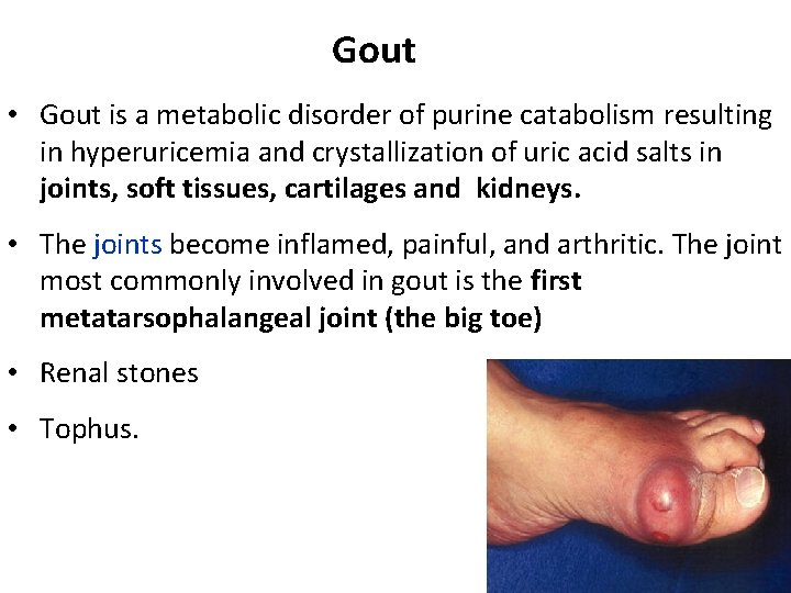 Gout • Gout is a metabolic disorder of purine catabolism resulting in hyperuricemia and