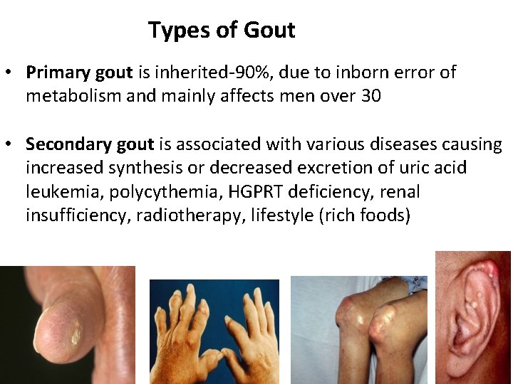 Types of Gout • Primary gout is inherited-90%, due to inborn error of metabolism