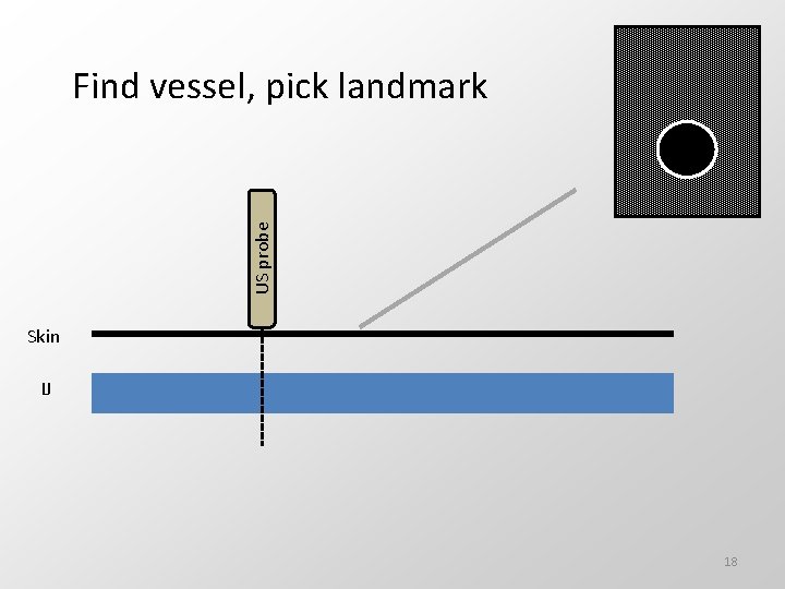 US probe Find vessel, pick landmark Skin IJ 18 