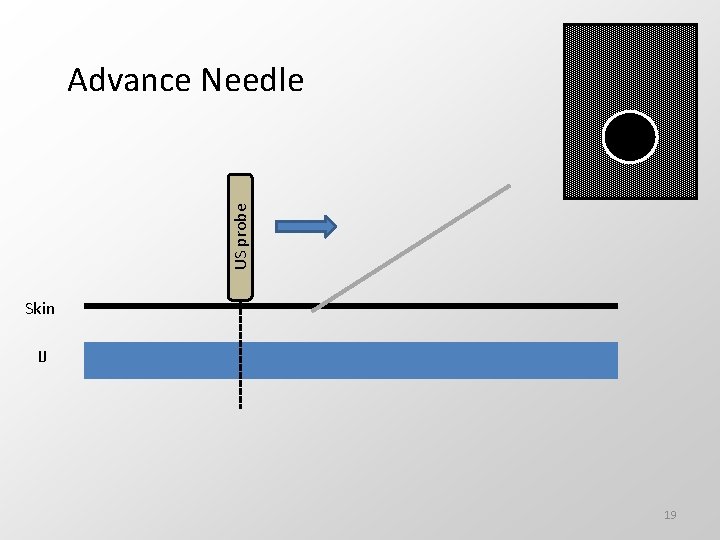 US probe Advance Needle Skin IJ 19 