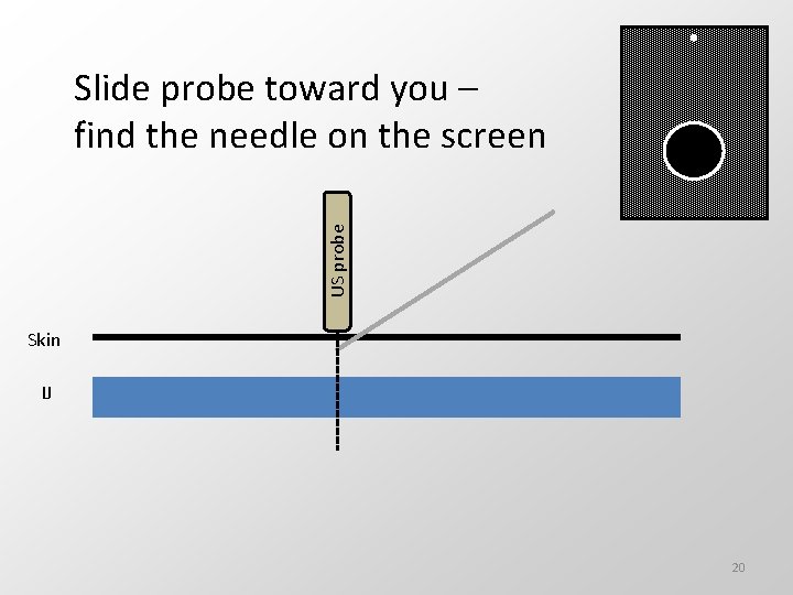 US probe Slide probe toward you – find the needle on the screen Skin