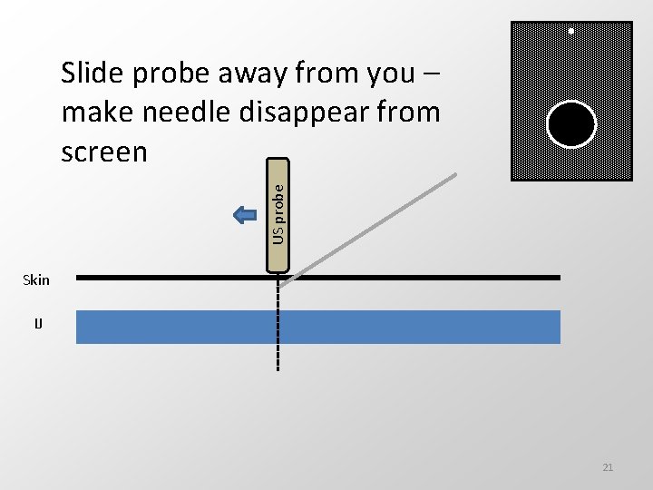 US probe Slide probe away from you – make needle disappear from screen Skin