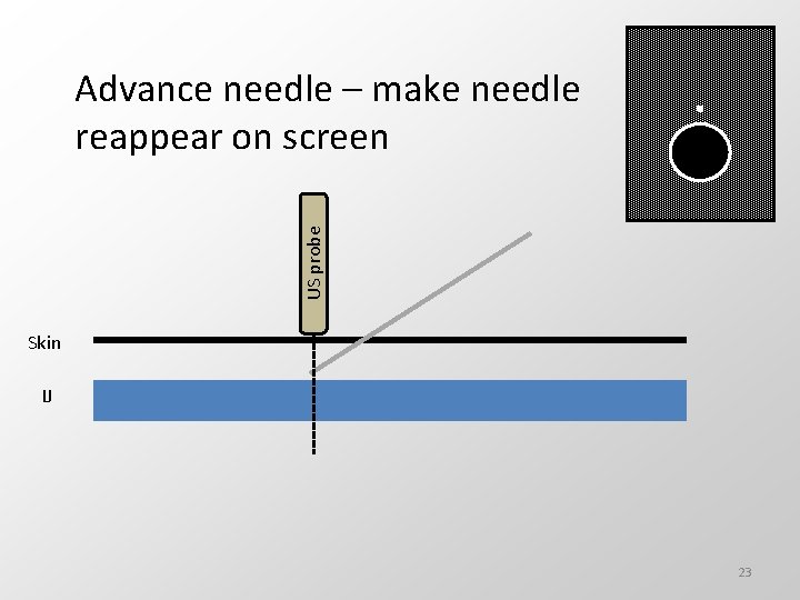 US probe Advance needle – make needle reappear on screen Skin IJ 23 