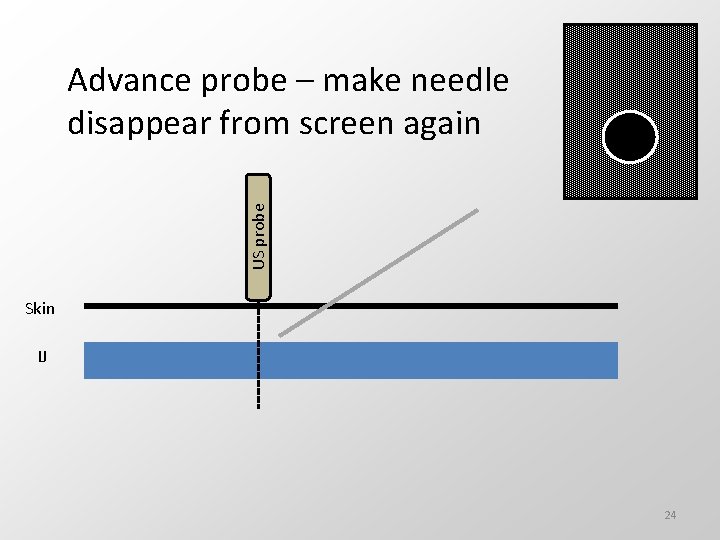US probe Advance probe – make needle disappear from screen again Skin IJ 24