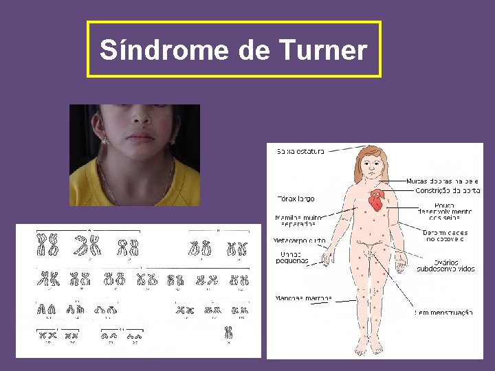 Síndrome de Turner 