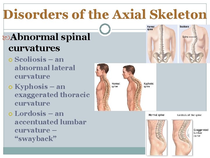 Disorders of the Axial Skeleton Abnormal spinal curvatures Scoliosis – an abnormal lateral curvature