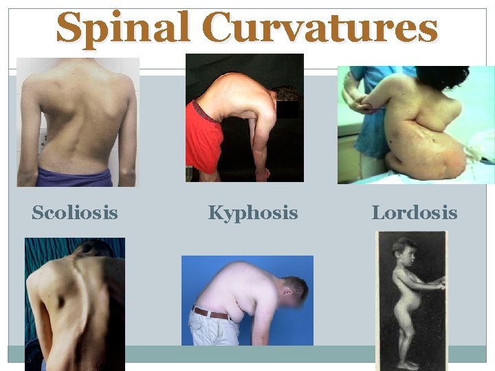 Spinal Curvatures Scoliosis Kyphosis Lordosis 