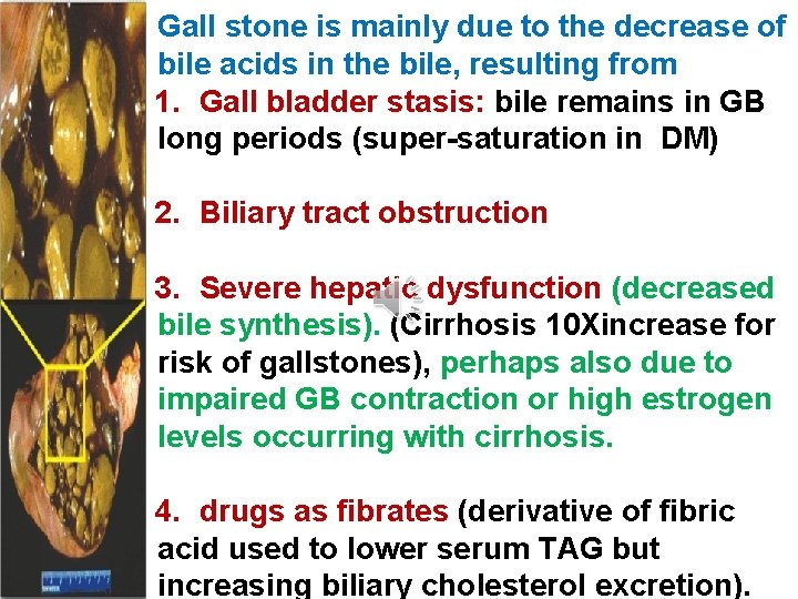 Gall stone is mainly due to the decrease of bile acids in the bile,