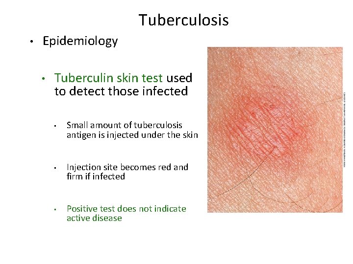 Tuberculosis • Epidemiology • Tuberculin skin test used to detect those infected • Small