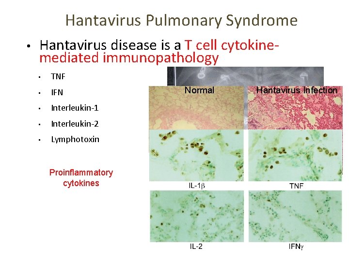 Hantavirus Pulmonary Syndrome • Hantavirus disease is a T cell cytokinemediated immunopathology • TNF