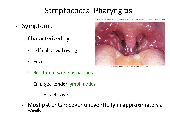 Streptococcal Pharyngitis • Symptoms • Characterized by • Difficulty swallowing • Fever • Red