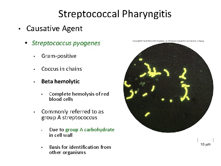 Streptococcal Pharyngitis • Causative Agent • Streptococcus pyogenes • Gram-positive • Coccus in chains