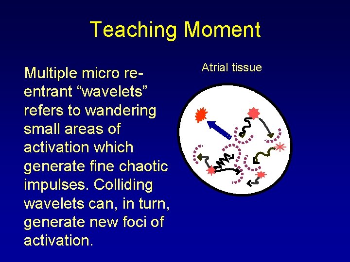 Teaching Moment Multiple micro reentrant “wavelets” refers to wandering small areas of activation which