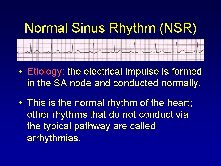 Normal Sinus Rhythm (NSR) • Etiology: the electrical impulse is formed in the SA