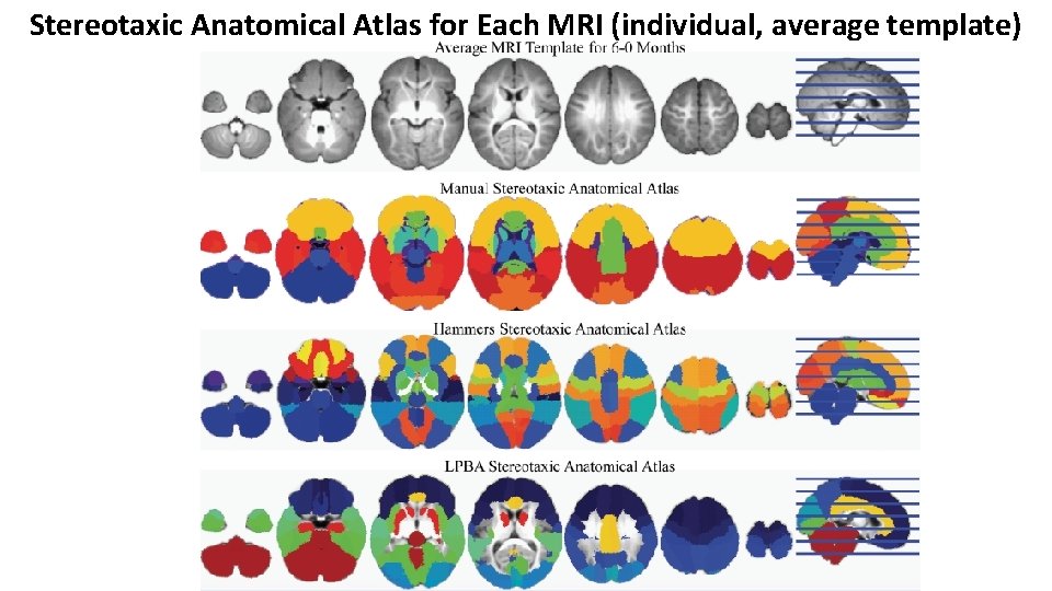 Stereotaxic Anatomical Atlas for Each MRI (individual, average template) Stereotaxic Anatomical Atlas for Each MRI (individual, average template)