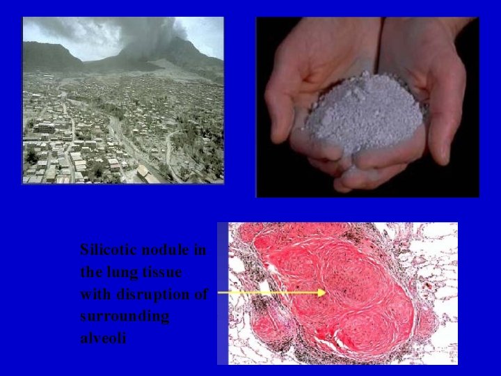 Silicotic nodule in the lung tissue with disruption of surrounding alveoli 