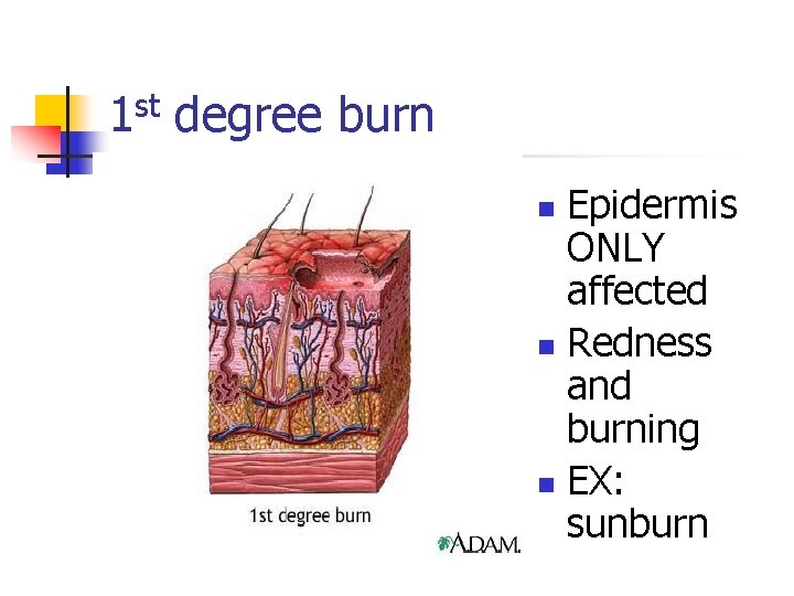 1 st degree burn Epidermis ONLY affected n Redness and burning n EX: sunburn