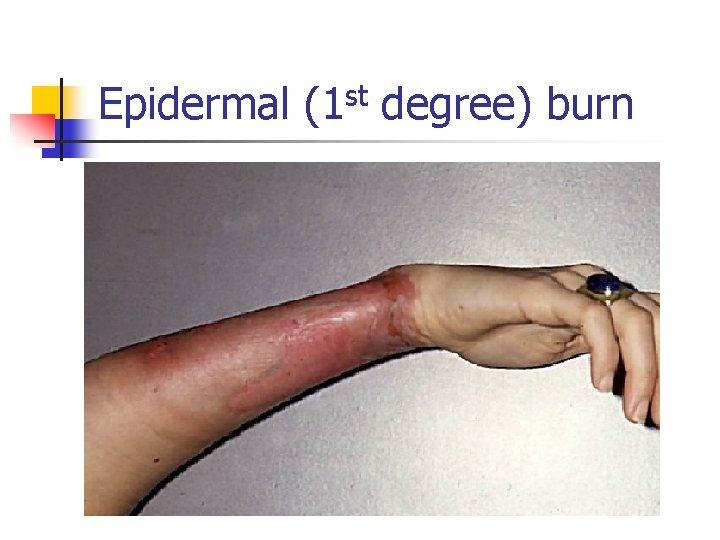 Epidermal (1 st degree) burn 