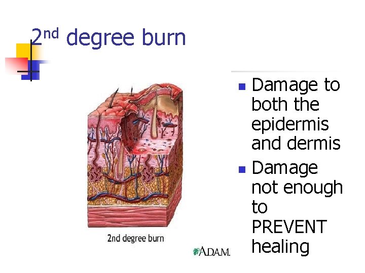 2 nd degree burn Damage to both the epidermis and dermis n Damage not
