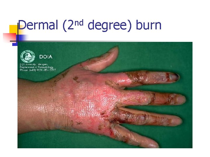 Dermal (2 nd degree) burn 