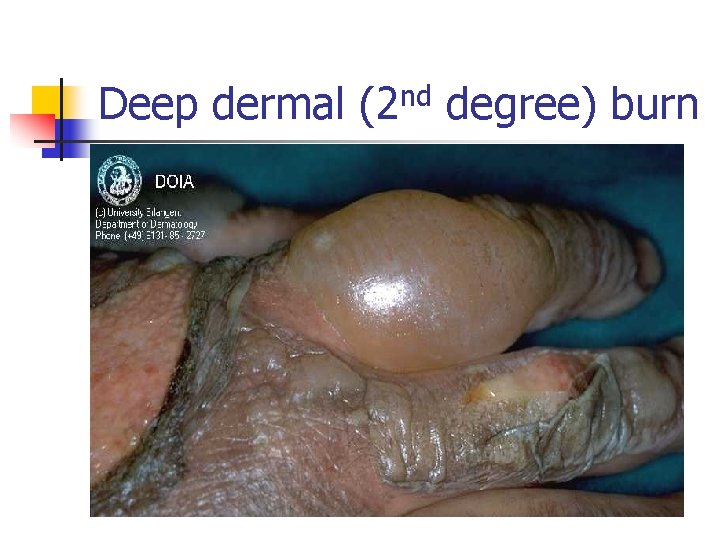 Deep dermal (2 nd degree) burn 